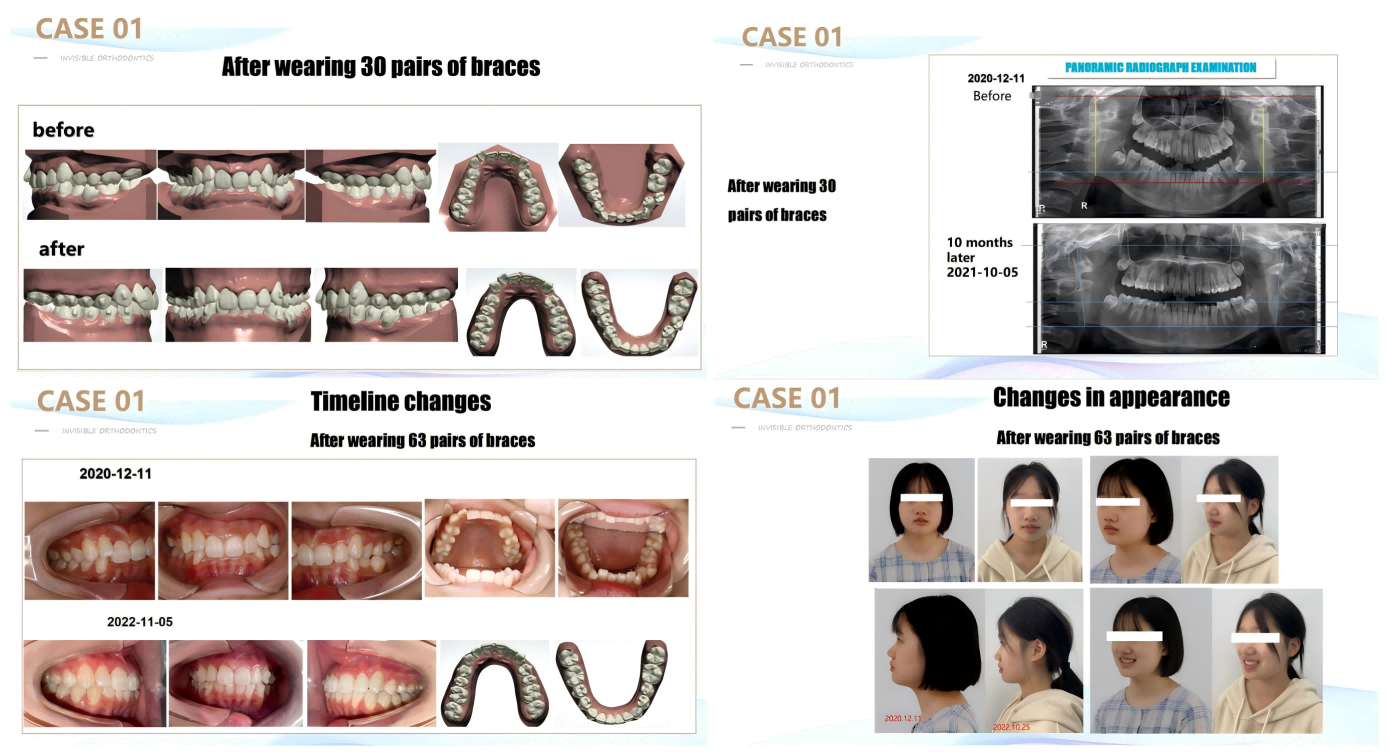 Precision in Motion: Transformative Full-Arch Alignment Case Study ...